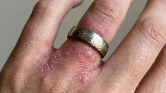 Zašto bižuterija izaziva alergiju na koži? Selesta